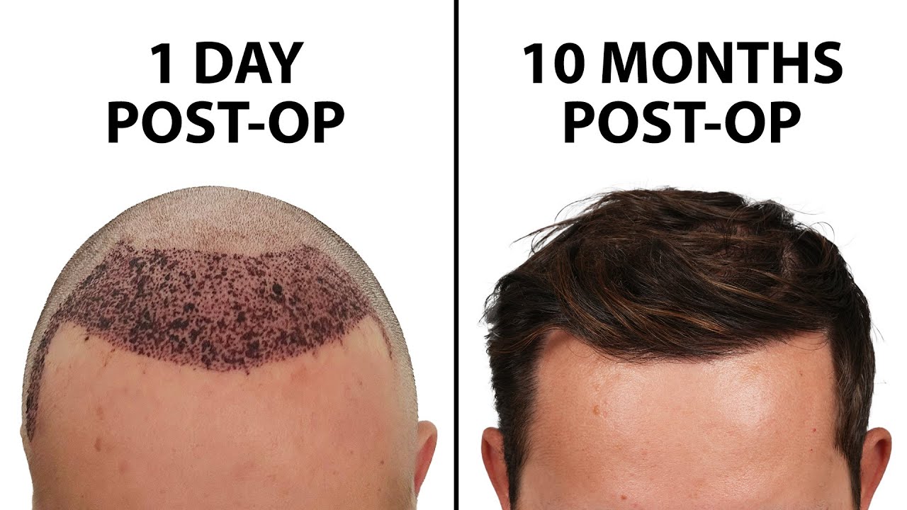 Hair Transplant UK for Thinning Hair – Get Your Confidence Back
